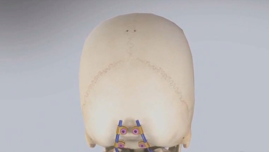 三友骨科耗材Cervrina醫(yī)學(xué)動(dòng)畫制作圖